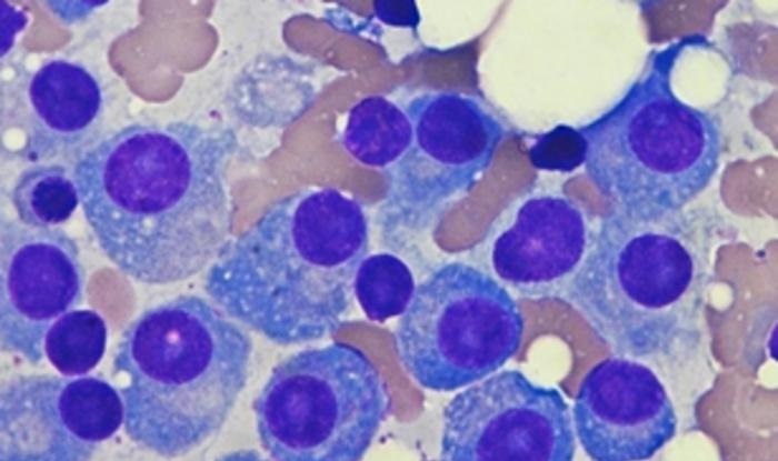 Image: Bone marrow affected by multiple myeloma, a disease against which PVR inhibition can increase the efficacy of immunotherapy (Photo courtesy of Cancer Epigenetics Group, IJC)